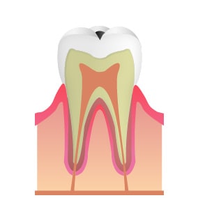 C1（エナメル質の虫歯）