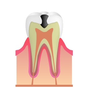 C2（象牙質の虫歯）