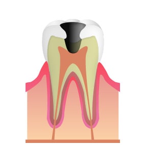 C3（神経まで進行した虫歯）