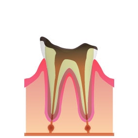 C4（歯の根まで進行した虫歯）