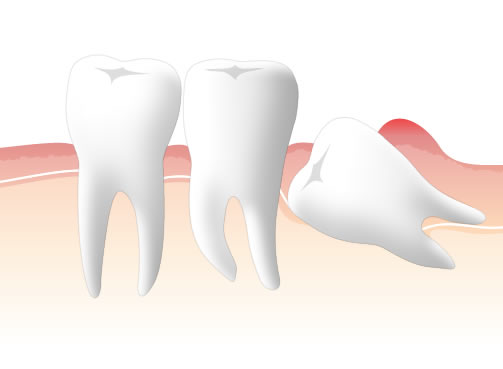 親知らずの抜歯